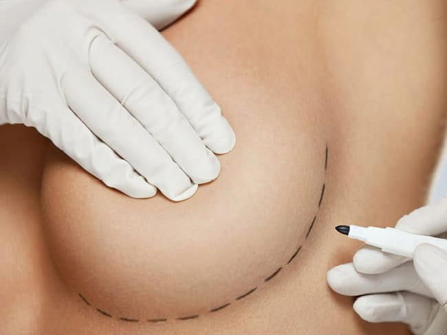 Breast Augmentation