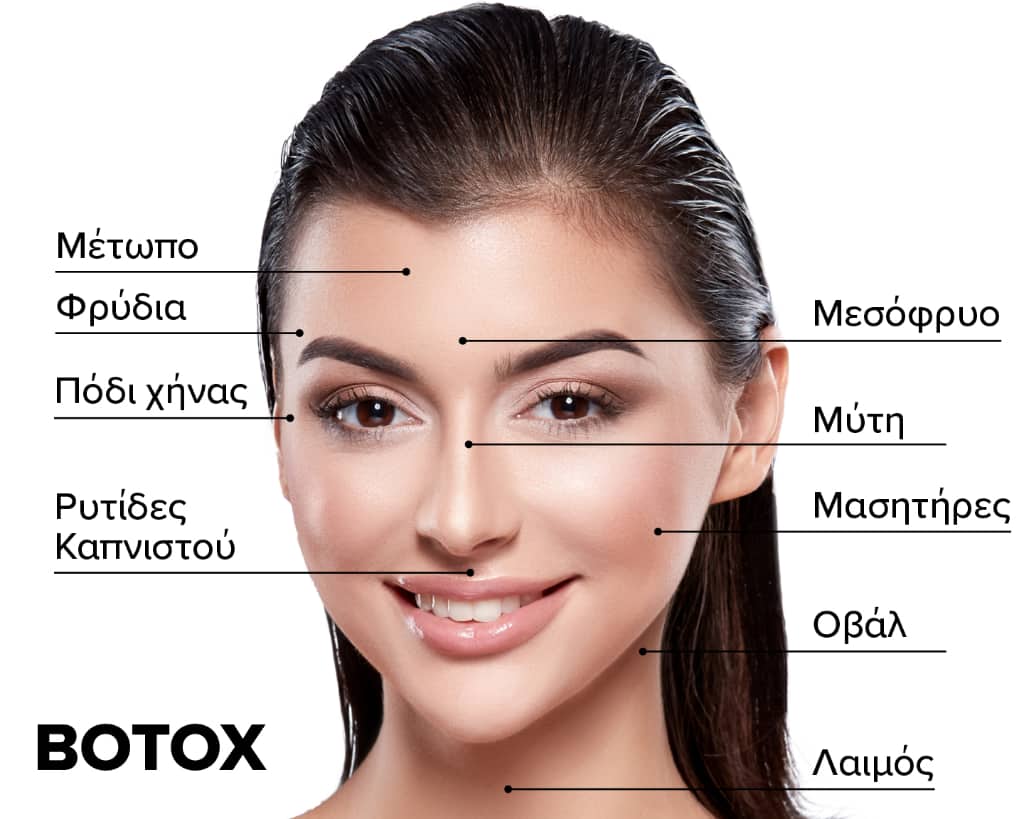 Σημεία εφαρμογής του Botox στο πρόσωπο.