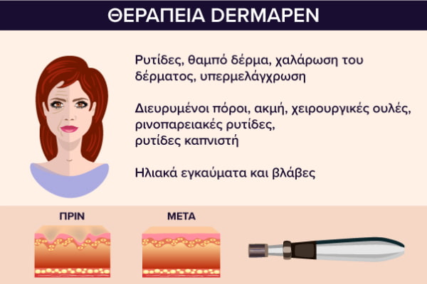 Πότε συστήνεται η θεραπεία με Dermapen.