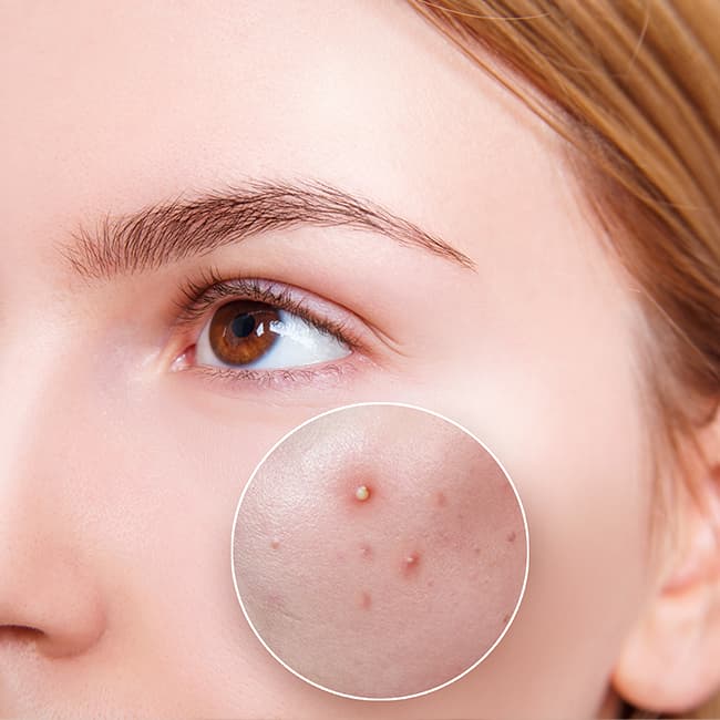PDT Photodynamic Acne Treatment