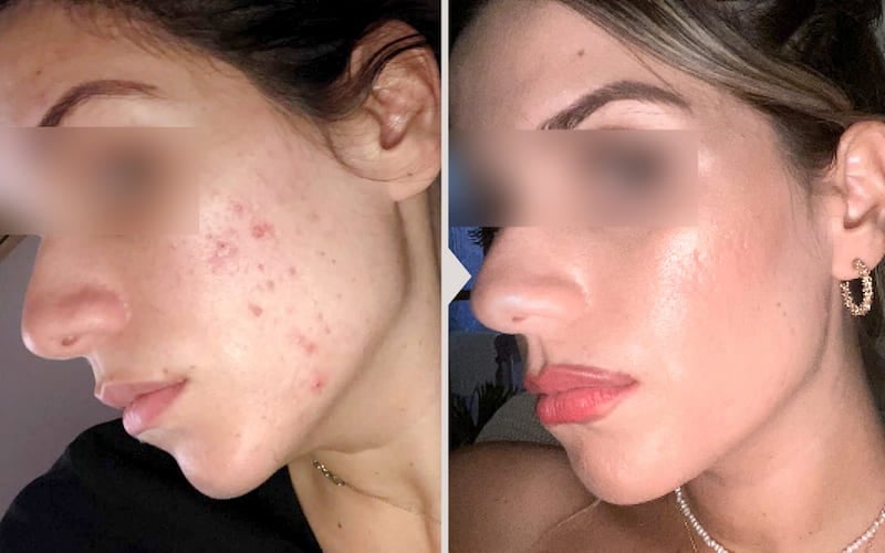 Results before and after Fractional laser treatment.