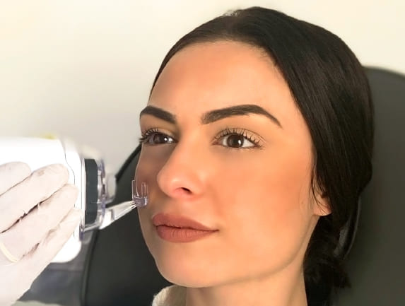 Ανανέωση της επιδερμίδας με Fractional Laser.