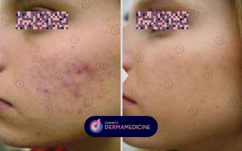 Αντιμετώπιση ουλών ακμής με Fractional Laser.