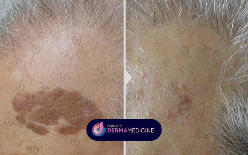Θεραπεία δερματικής πάθησης με Fractional Laser.