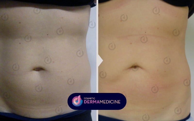 Cryolipolysis results before after