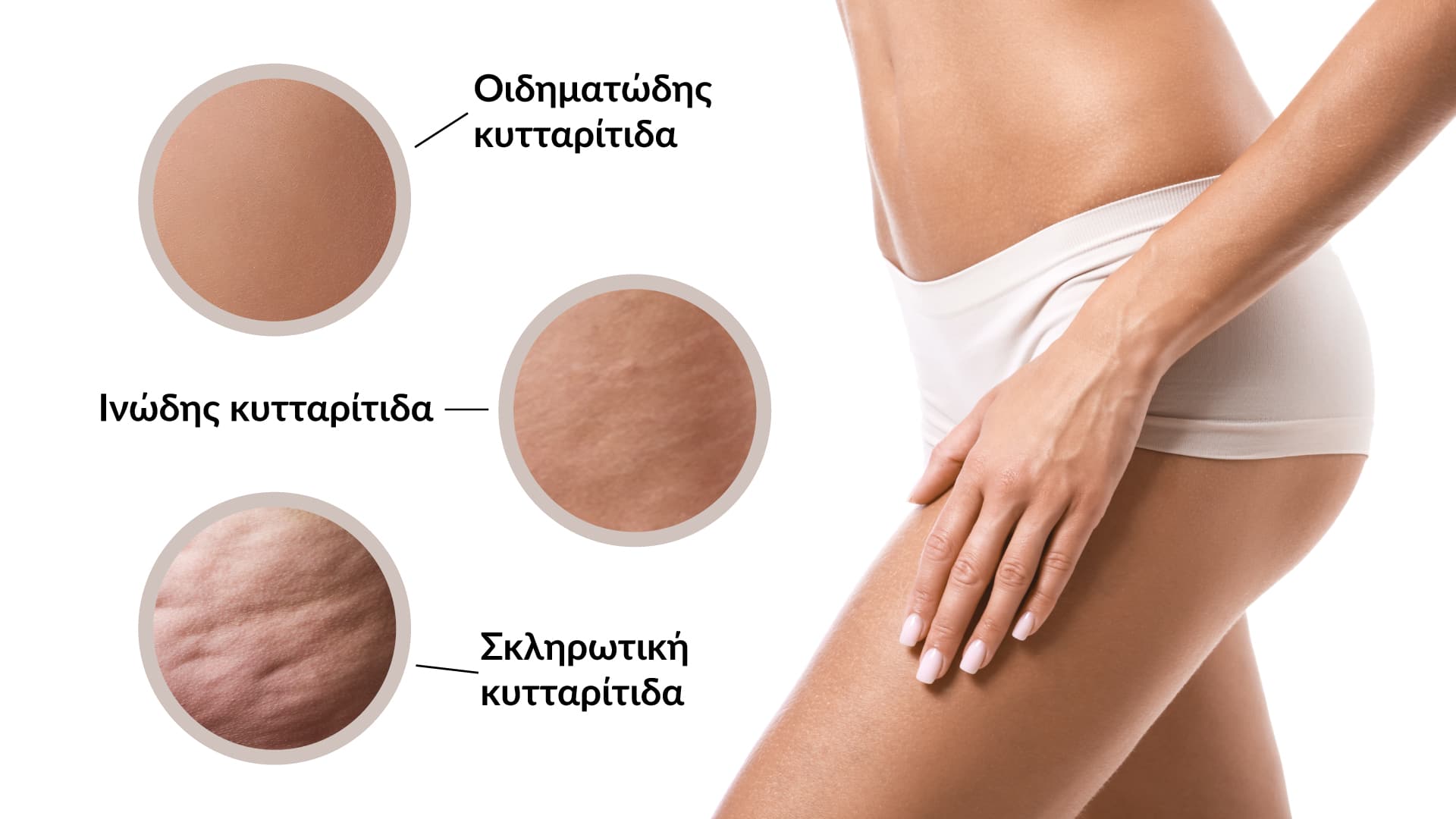 Τα στάδια της κυτταρίτιδας.