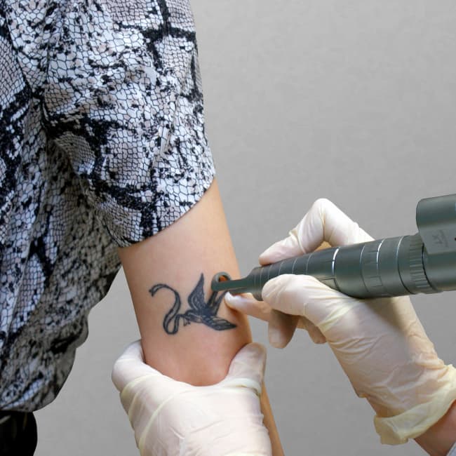 Laser Tattoo Removal