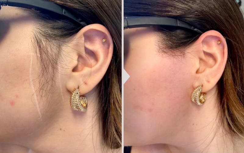 Results before and after laser hair removal.