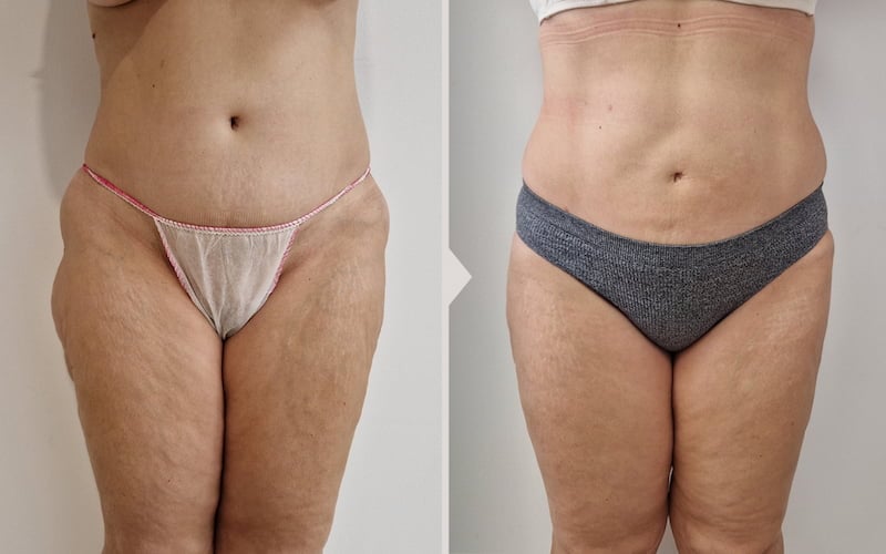 Results before and after laser liposuction.