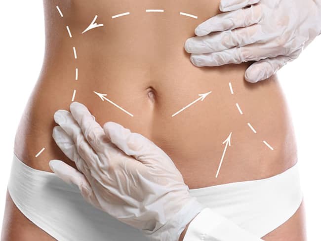 Liposuction