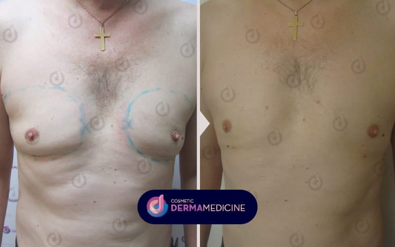 Λιποαναρρόφηση με laser στο στήθος.