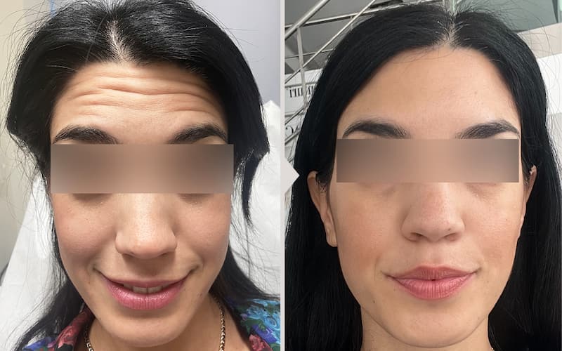 Results before and after neurotoxin treatment.