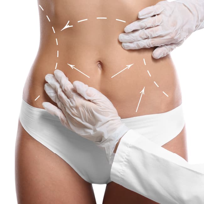 Body Thread Lift