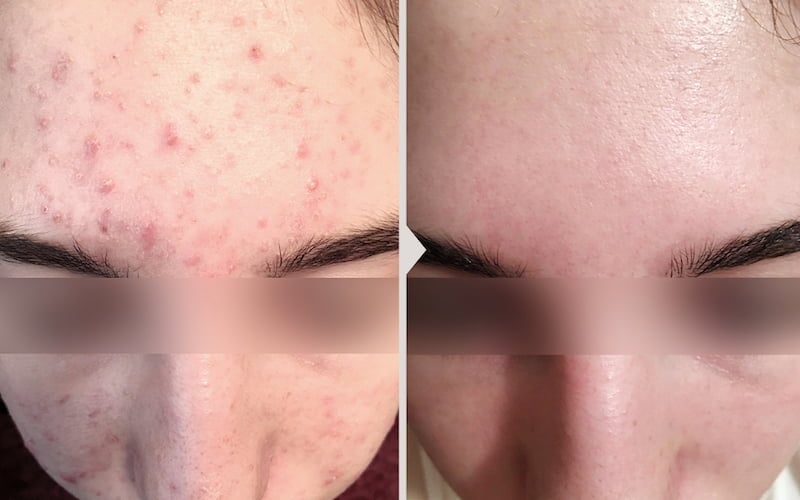 Results before and after acne treatment.