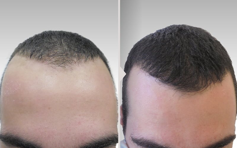 Results before and after hair loss treatment.