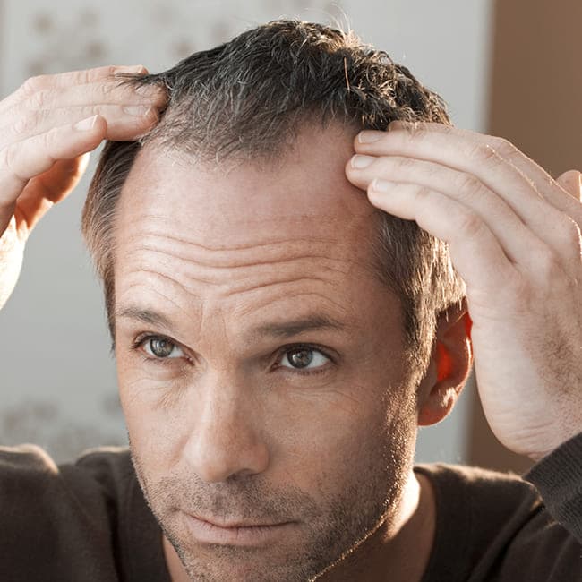 What is Hair Loss