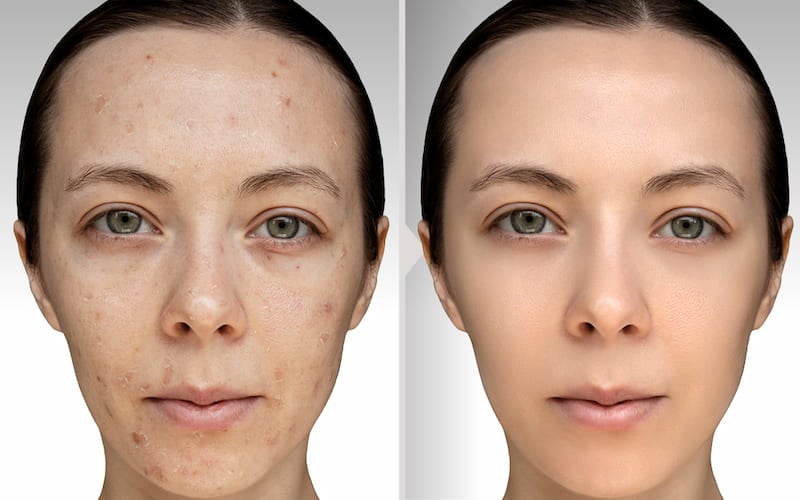Results before and after chemical peelings treatment.